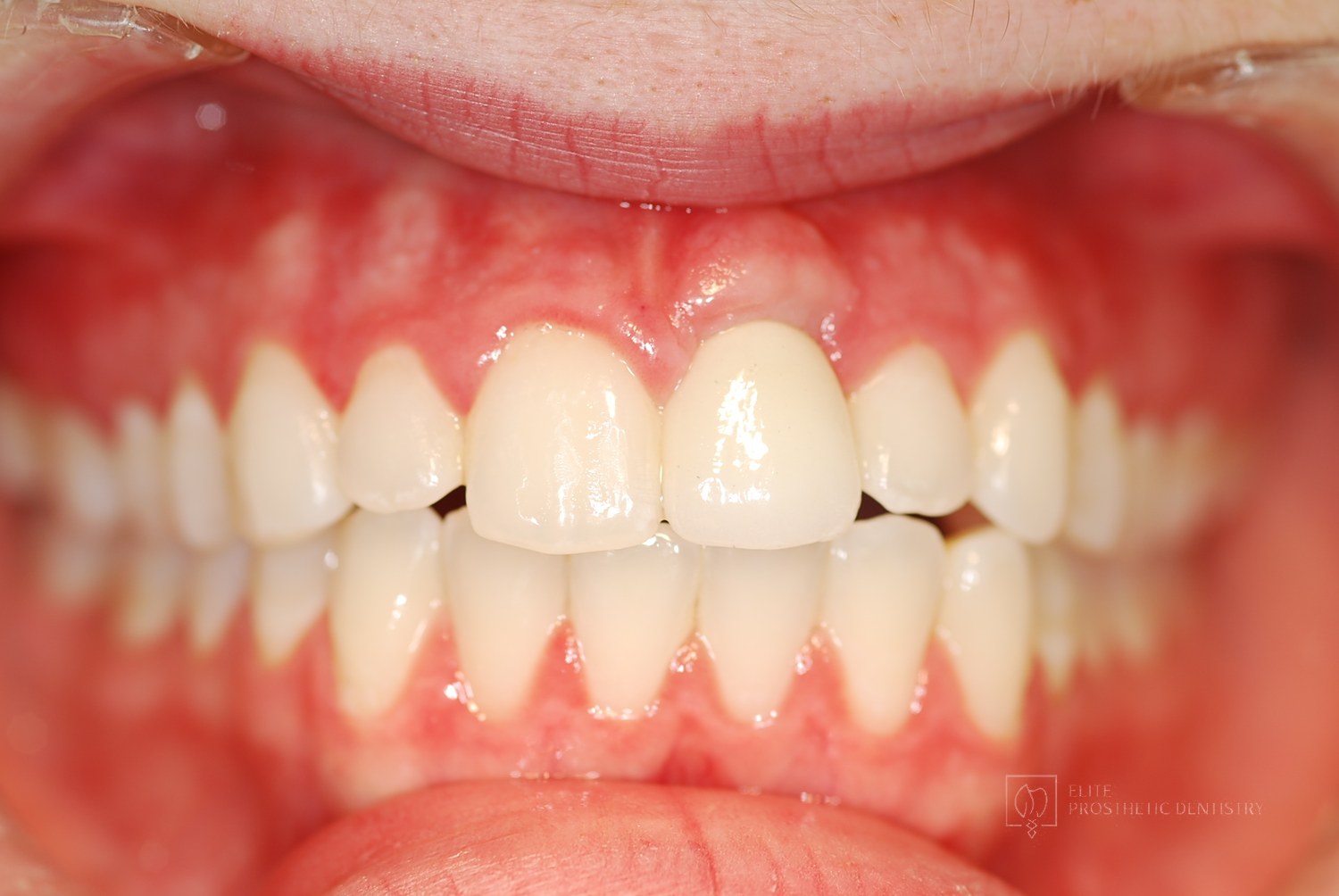 After: retracted intraoral view of the finished implant crown matching the adjacent natural teeth
