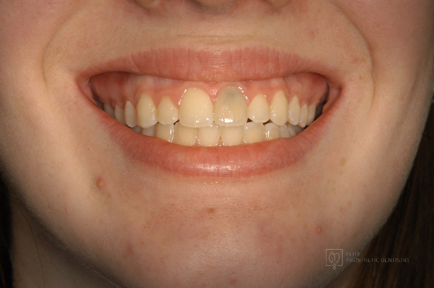 Before: How a Front Tooth Lost to Childhood Trauma Was Rebuilt with Bone Grafting and a Long-Lasting Implant