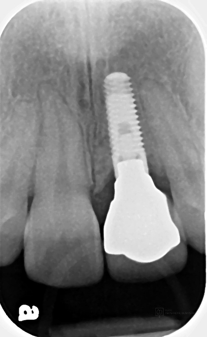 Radiograph of the anterior implant supporting the restored central incisor, well integrated in healthy surrounding bone