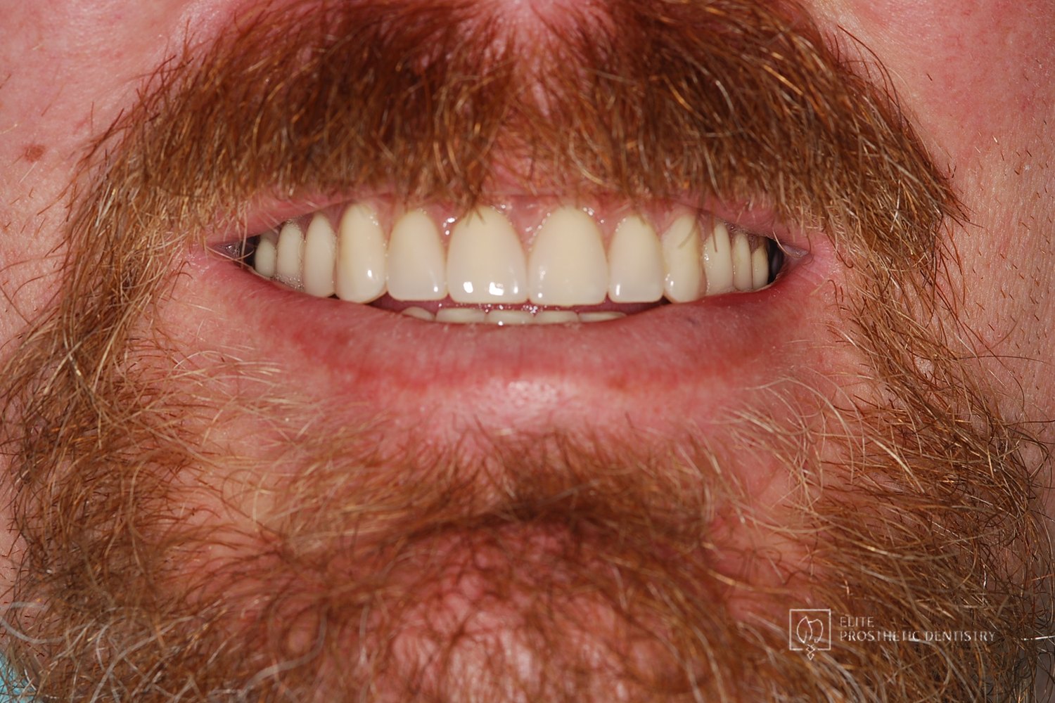 The completed smile after full-arch implant reconstruction of the upper and lower arches.