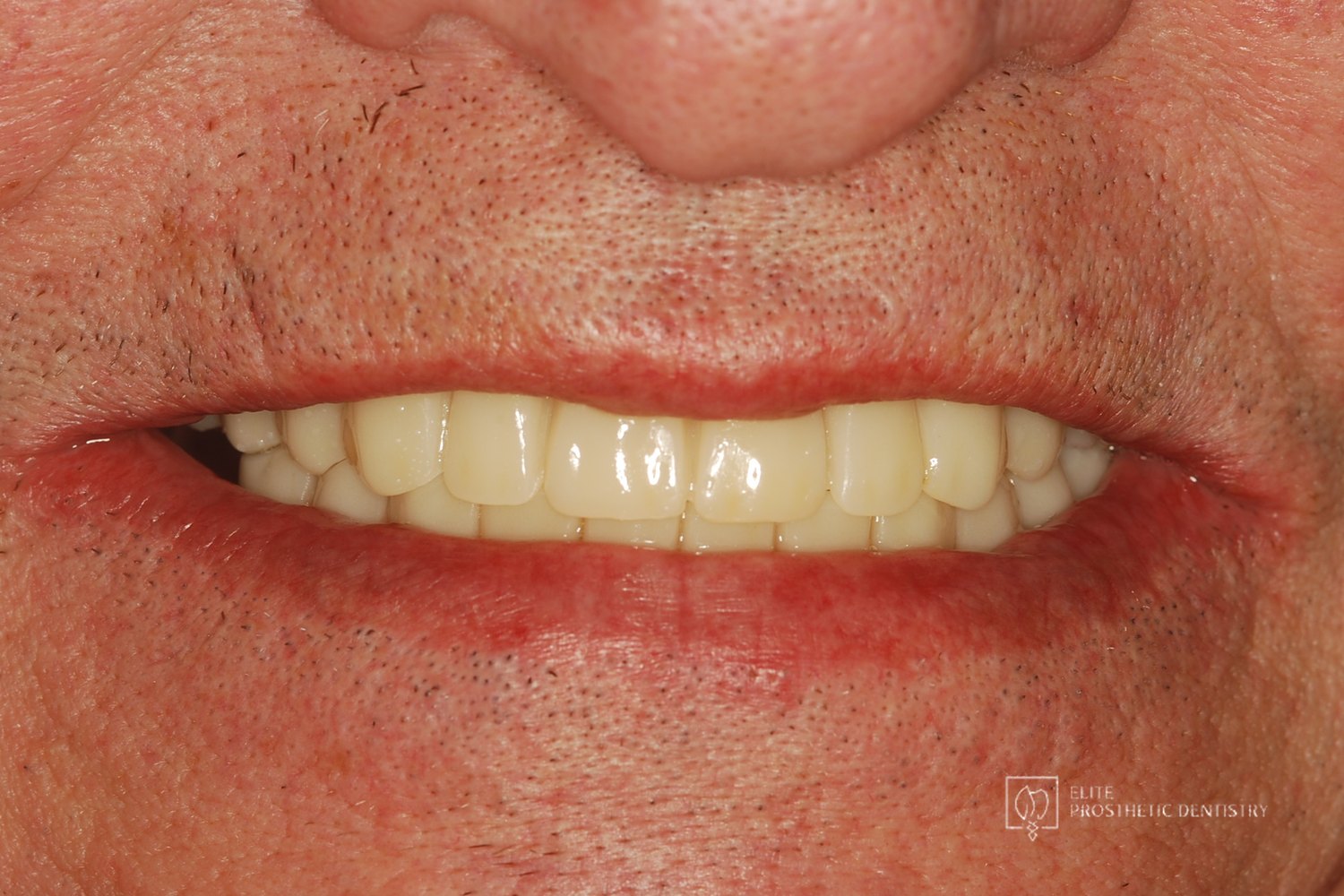 Completed smile close-up after treatment