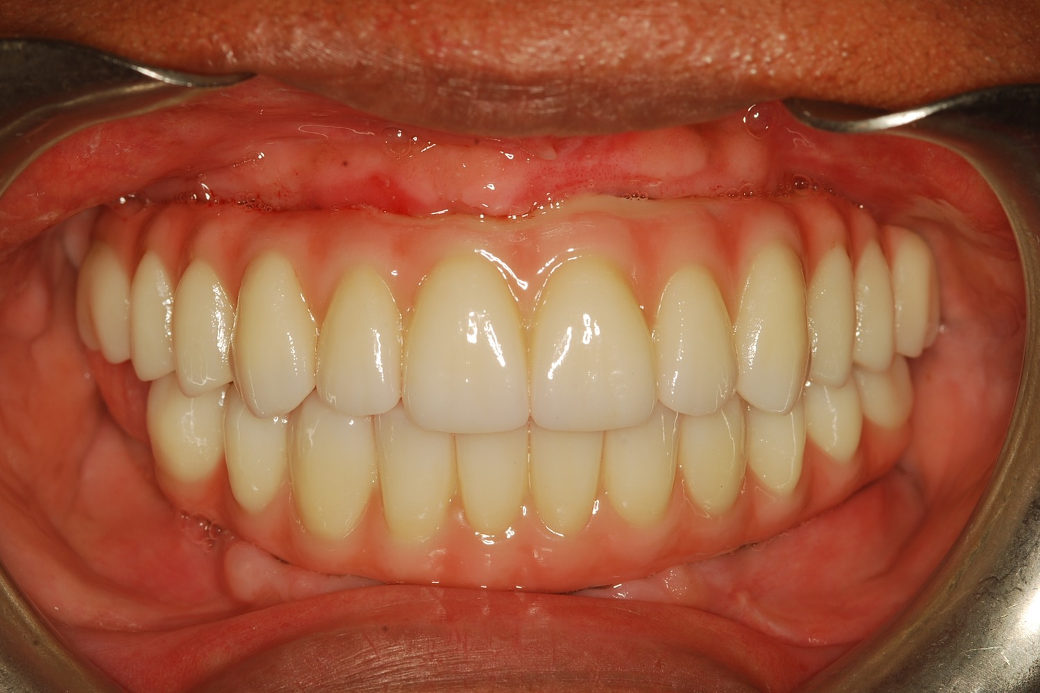 After: How Severe Bone Loss and Bite Dysfunction Were Rebuilt with All-on-6 Implants and a Milled Zirconia Hybrid Prosthesis