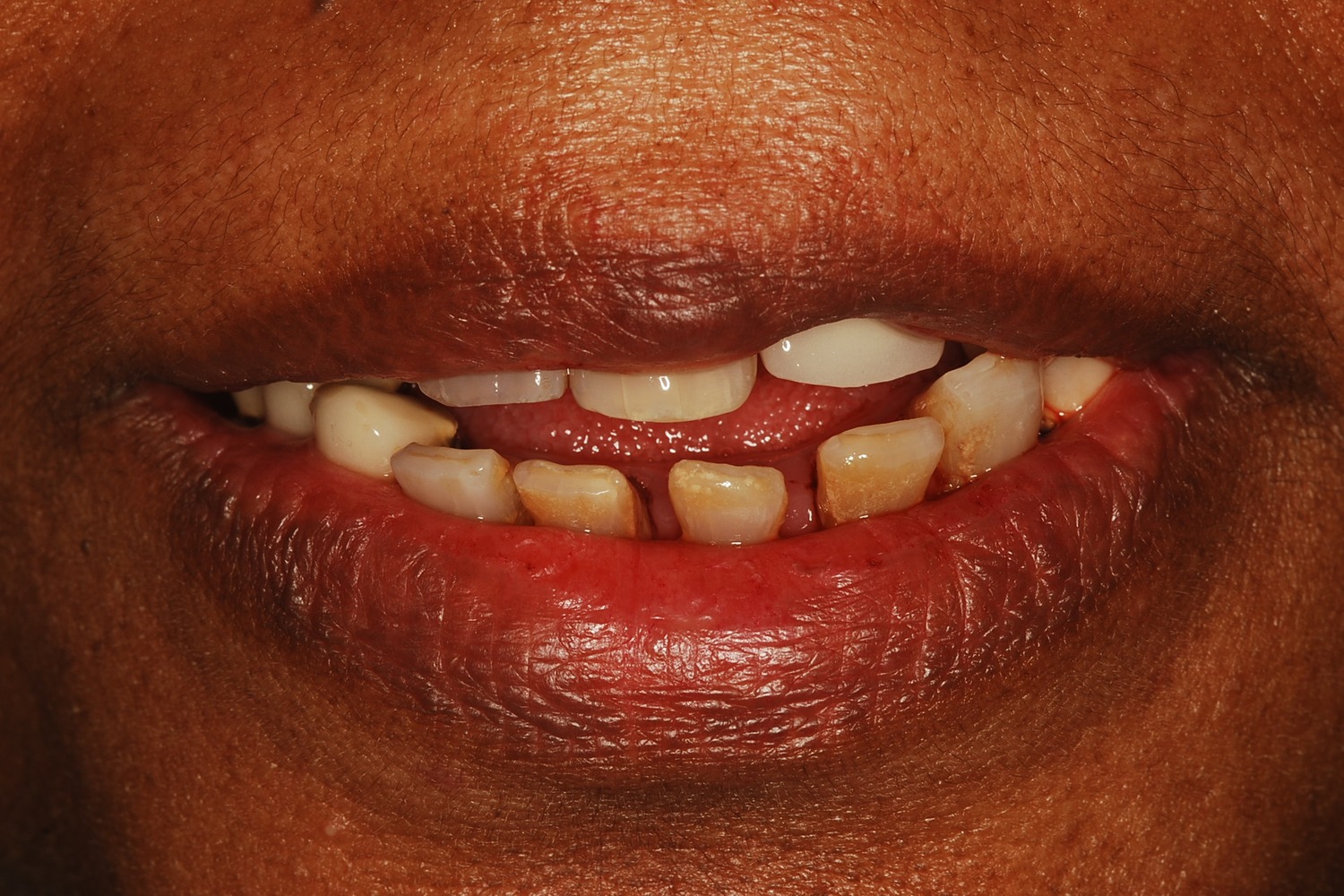 Before treatment