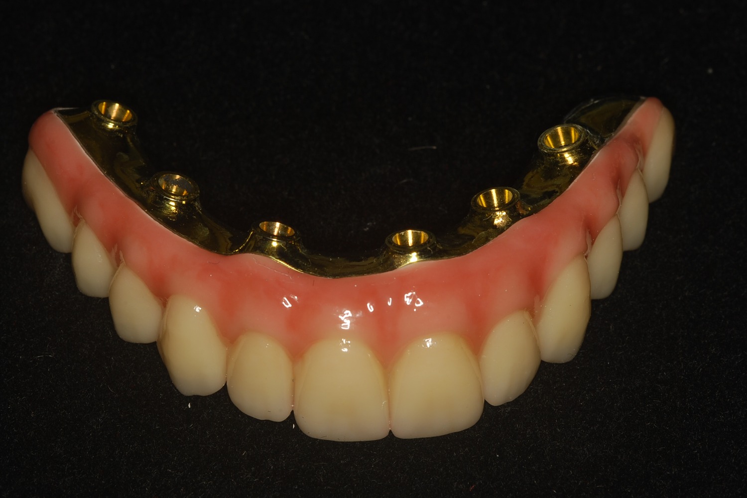 The milled zirconia upper full-arch prosthesis on its titanium bar