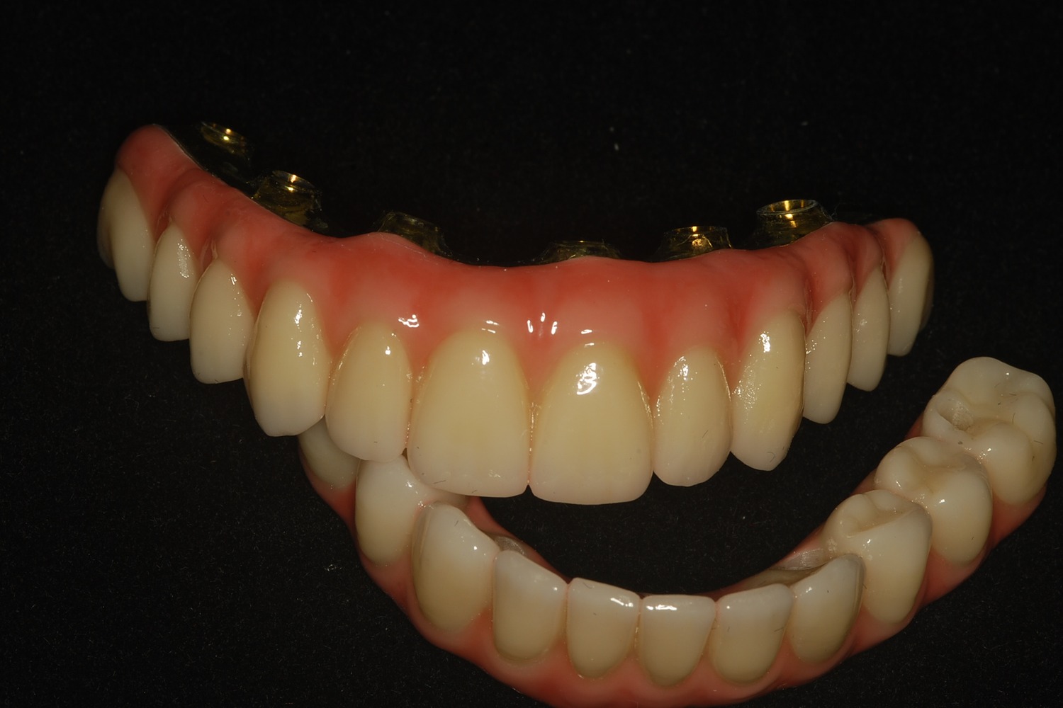 The completed upper and lower full-arch prostheses shown together