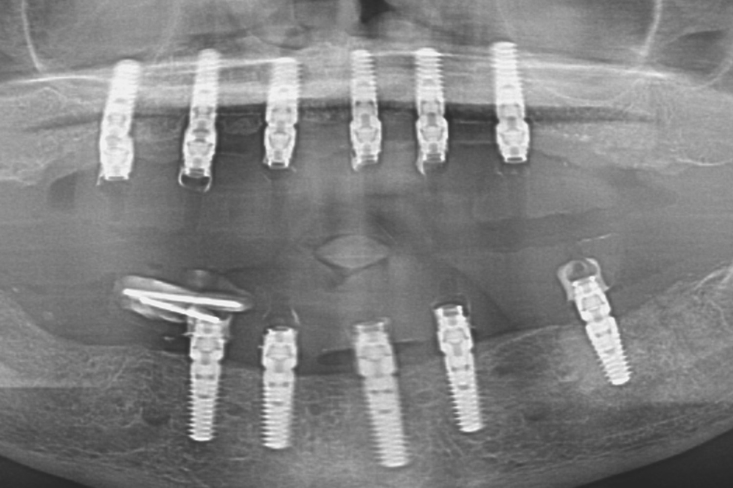 Panoramic radiograph confirming the placed implants in both arches
