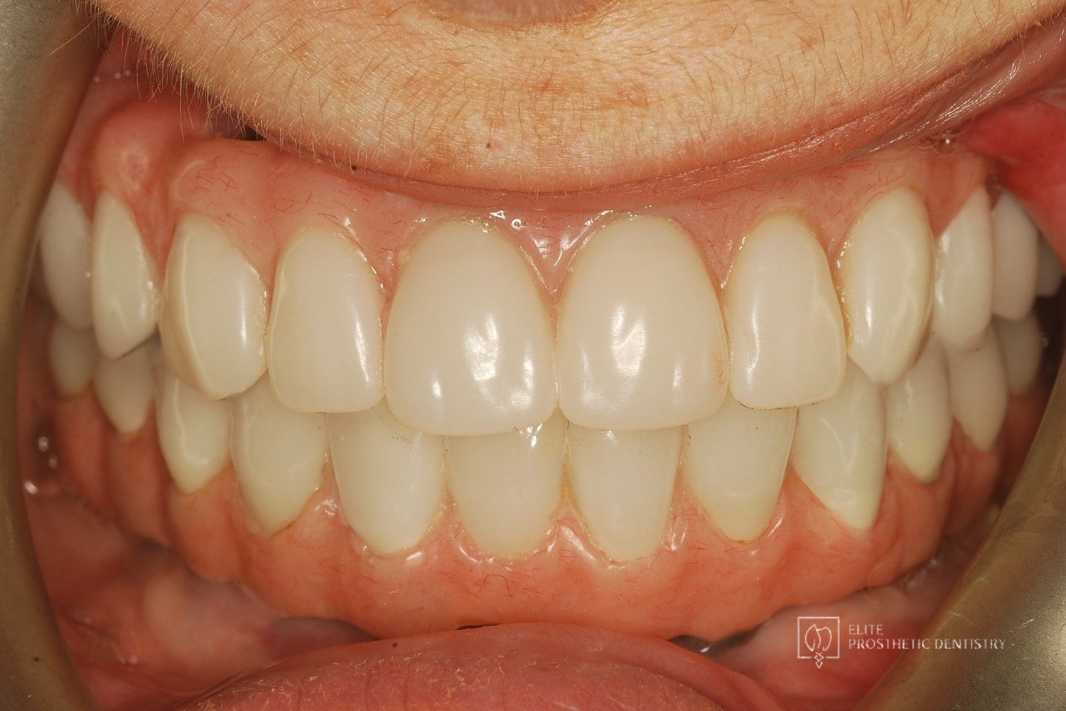 After: How Failing Implants and Severe Bone Loss Were Rebuilt Into a Stable Full-Arch Implant Reconstruction