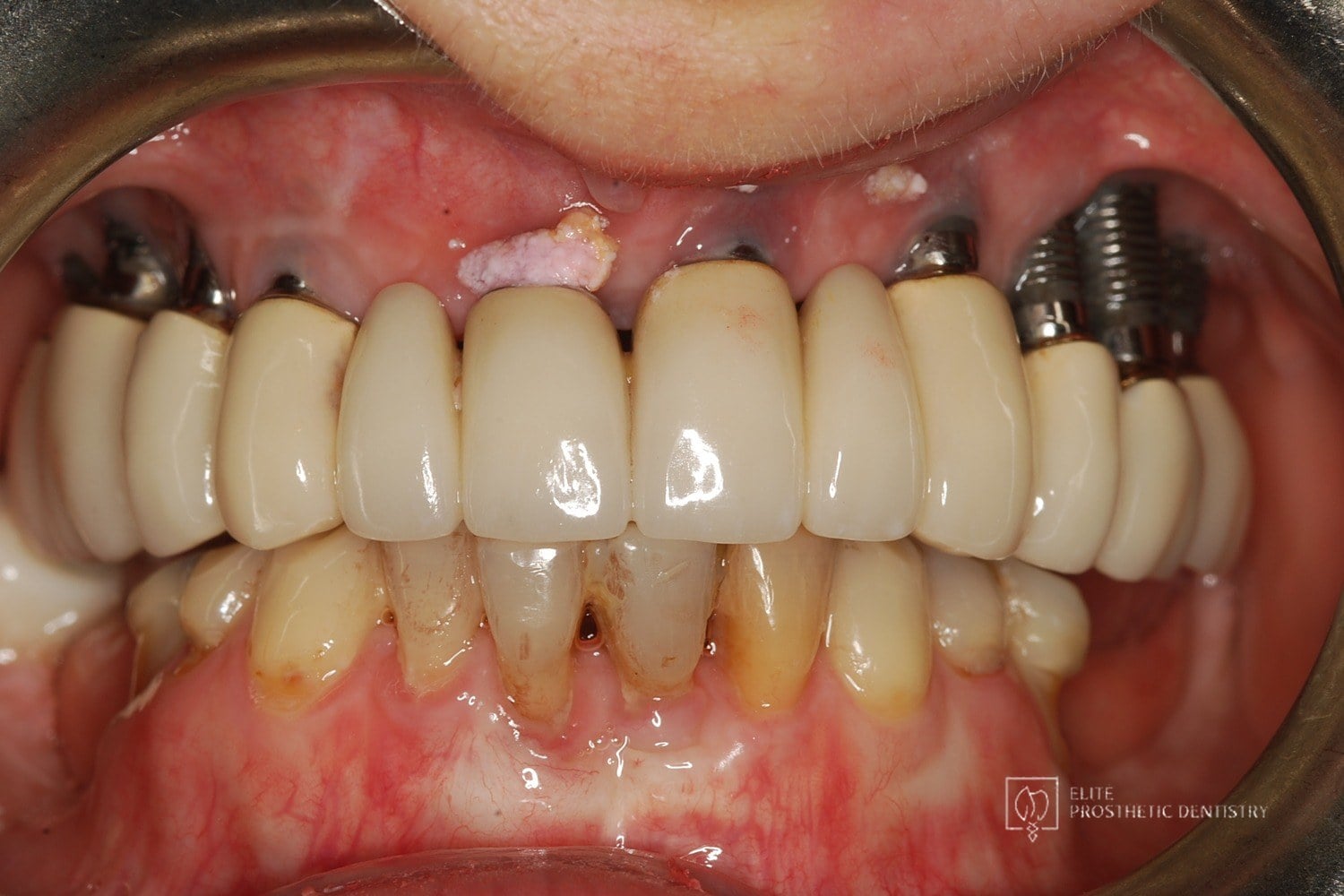 Before: How Failing Implants and Severe Bone Loss Were Rebuilt Into a Stable Full-Arch Implant Reconstruction
