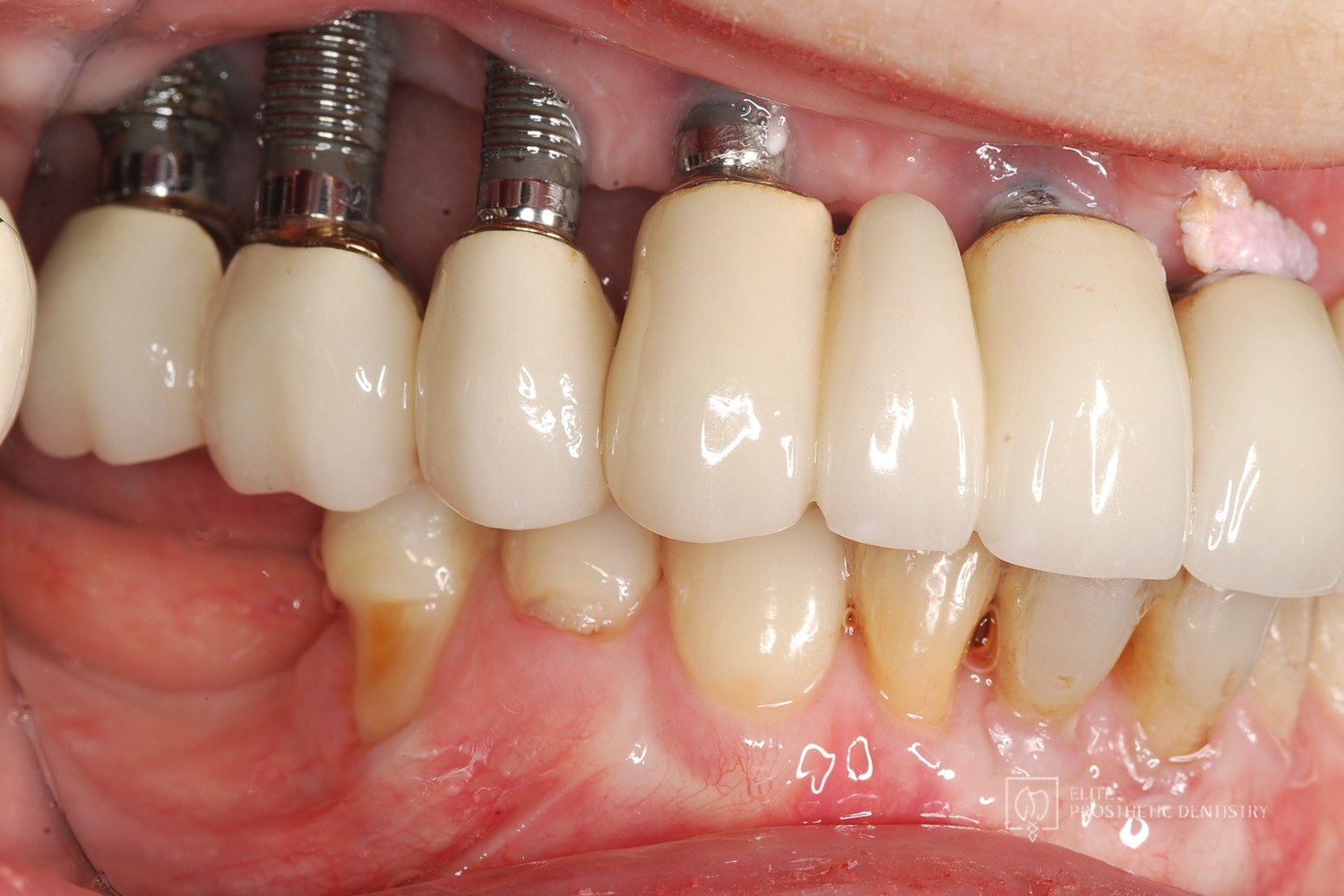 Pre-treatment side view showing the extent of bone loss and the position of the failing implants.