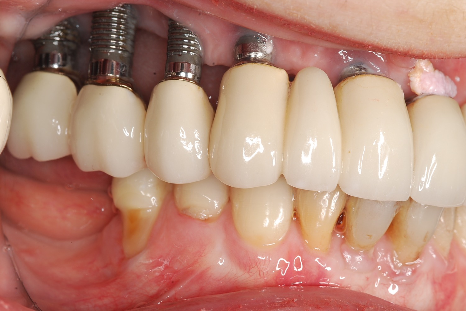 Pre-treatment side view showing the extent of bone loss and position of the fail