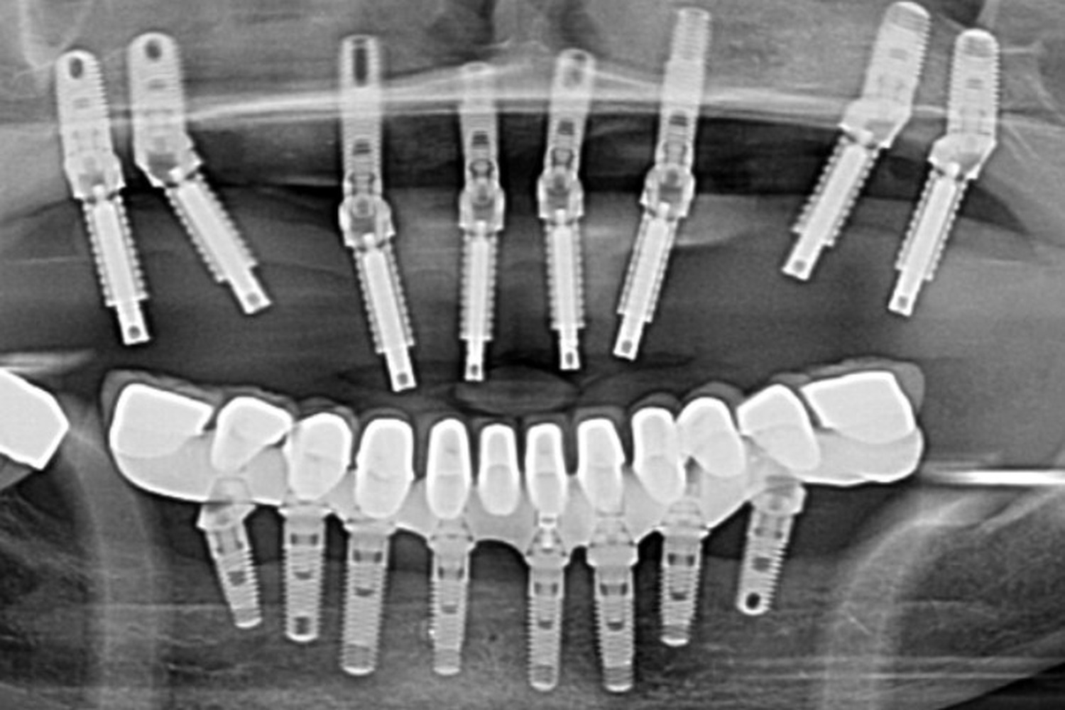 Panoramic radiograph showing the new implant placement and the framework support