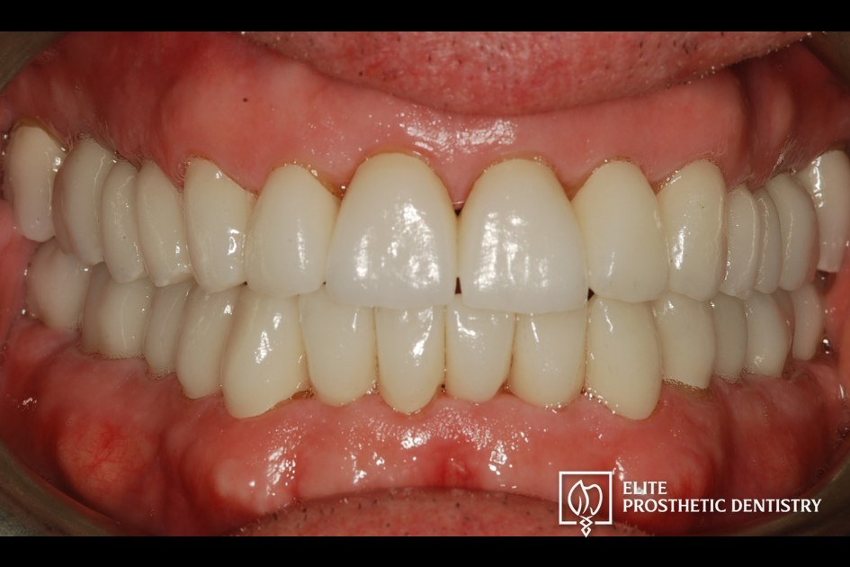 After: retracted intraoral view following the coordinated reconstruction with new crowns and bridge