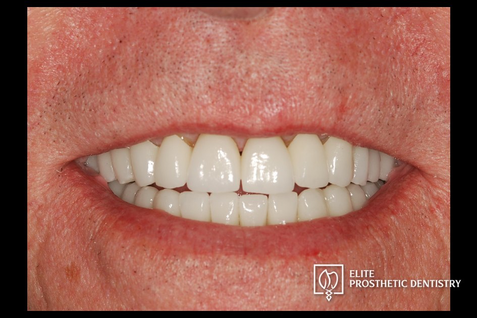 After: How Aging Crowns and a Long-Standing Bridge Were Rebuilt with a Coordinated Restorative Plan