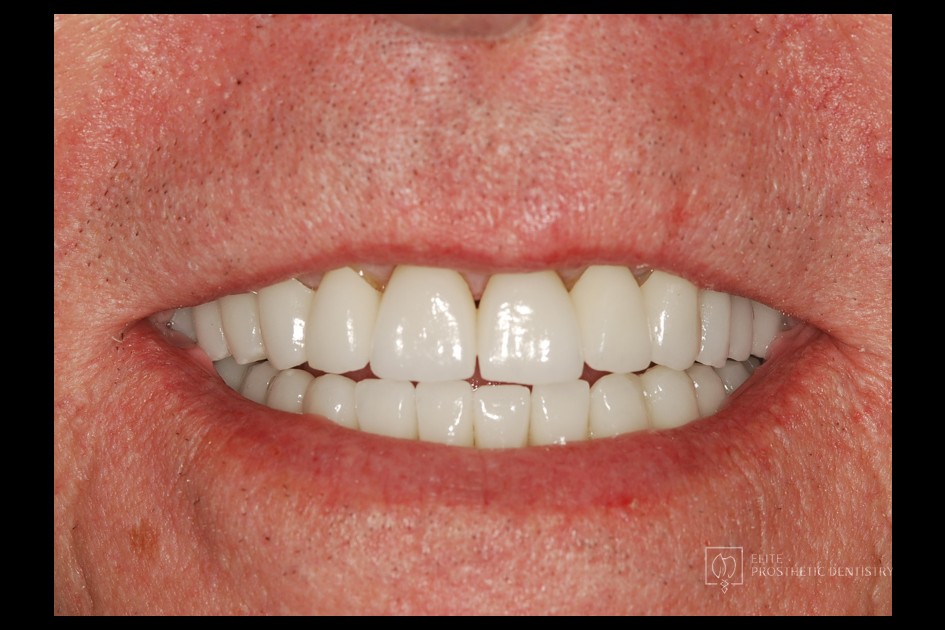 After: How Aging Crowns and a Long-Standing Bridge Were Rebuilt with a Coordinated Restorative Plan