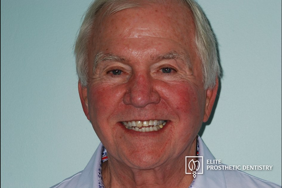 Before: full-face view before the coordinated restorative reconstruction of aging crowns and a long-standing bridge