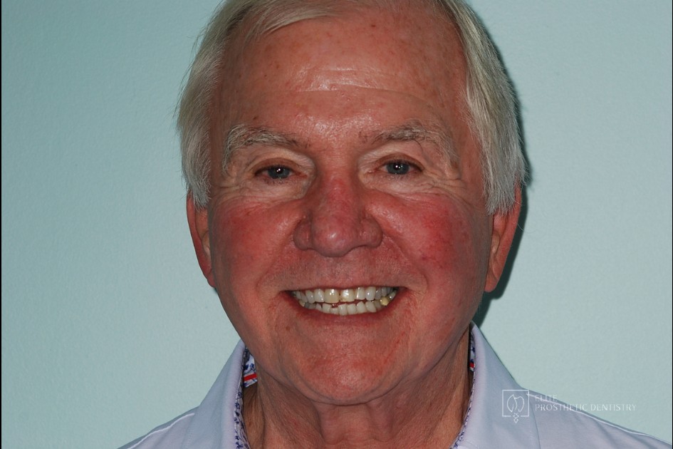 Before: full-face view before the coordinated restorative reconstruction of aging crowns and a long-standing bridge