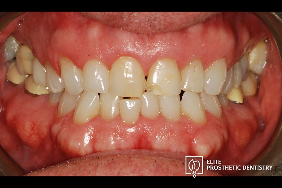 Before: retracted intraoral view documenting the extent of the aging dentistry