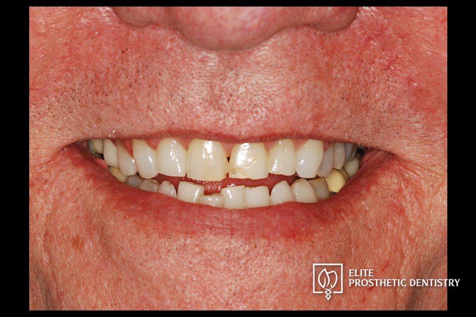Before: How Aging Crowns and a Long-Standing Bridge Were Rebuilt with a Coordinated Restorative Plan