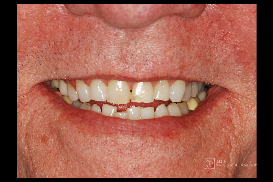 Before: How Aging Crowns and a Long-Standing Bridge Were Rebuilt with a Coordinated Restorative Plan