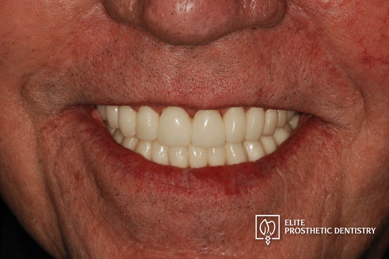 Provisional phase: retracted view of the provisionals in centric occlusion, confirming the design before final fabrication