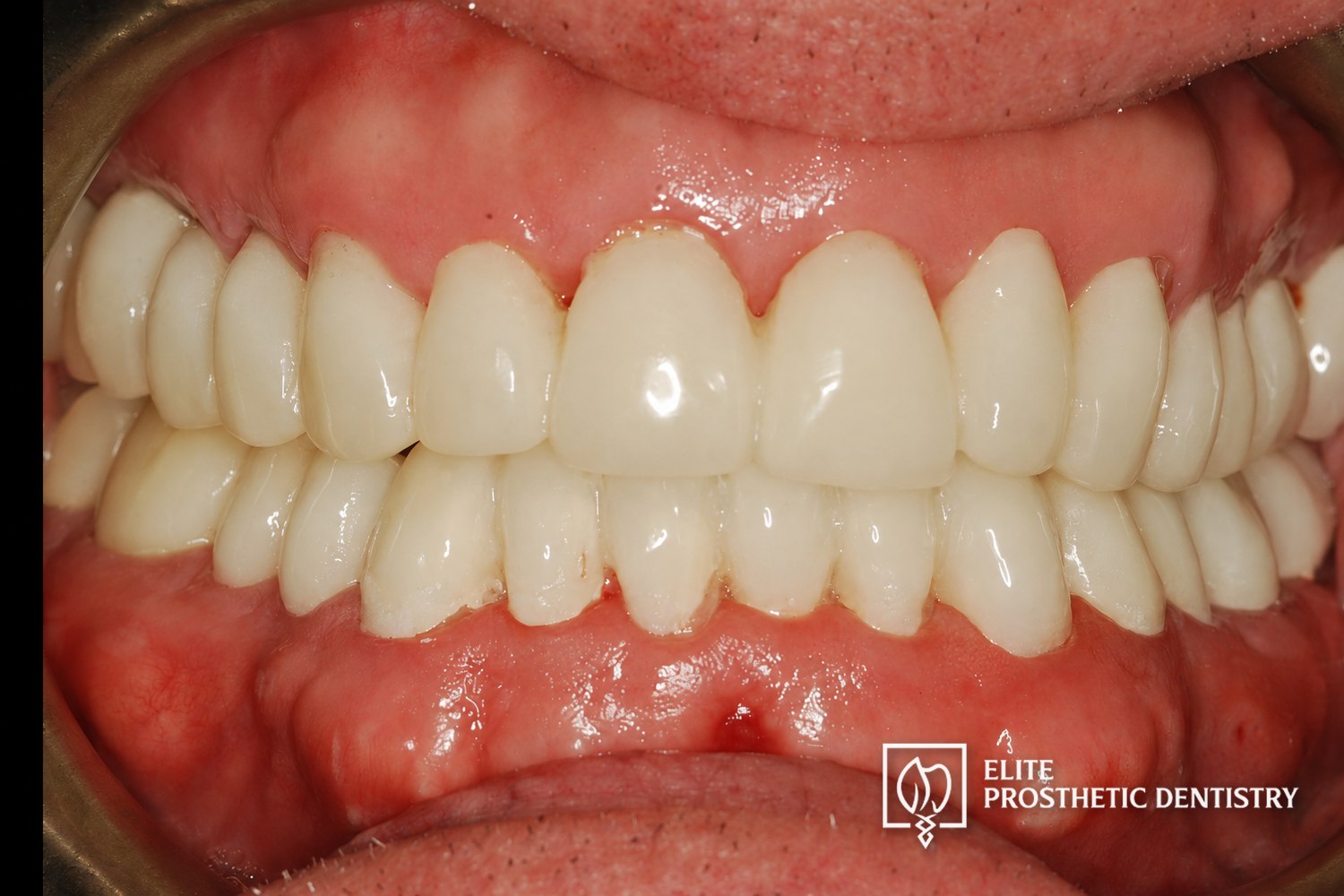 Provisional phase: smile-line view of the temporary crowns and bridge verifying the planned form and bite in function