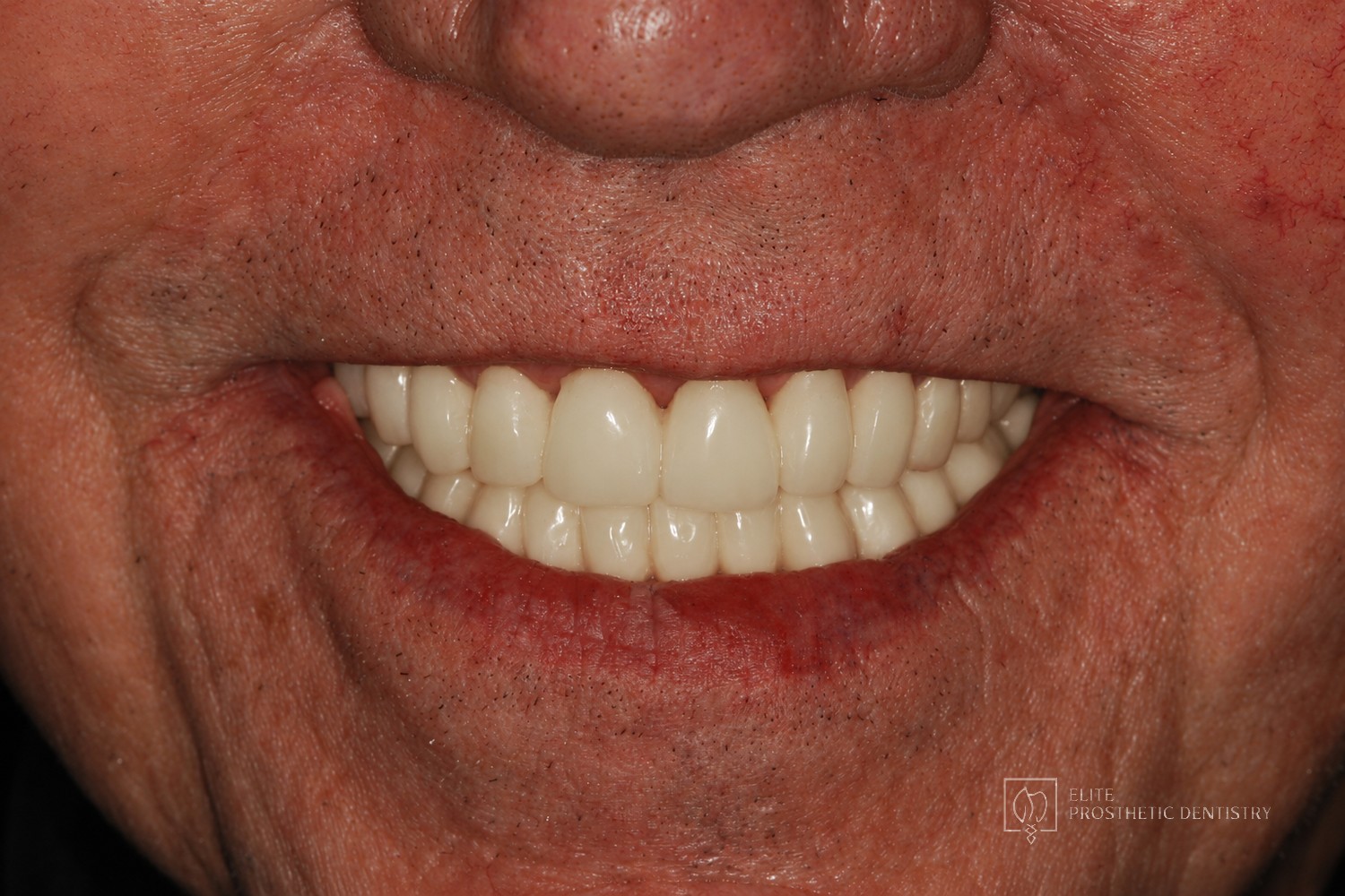 Provisional phase: smile-line view of the temporary crowns and bridge verifying the planned form and bite in function