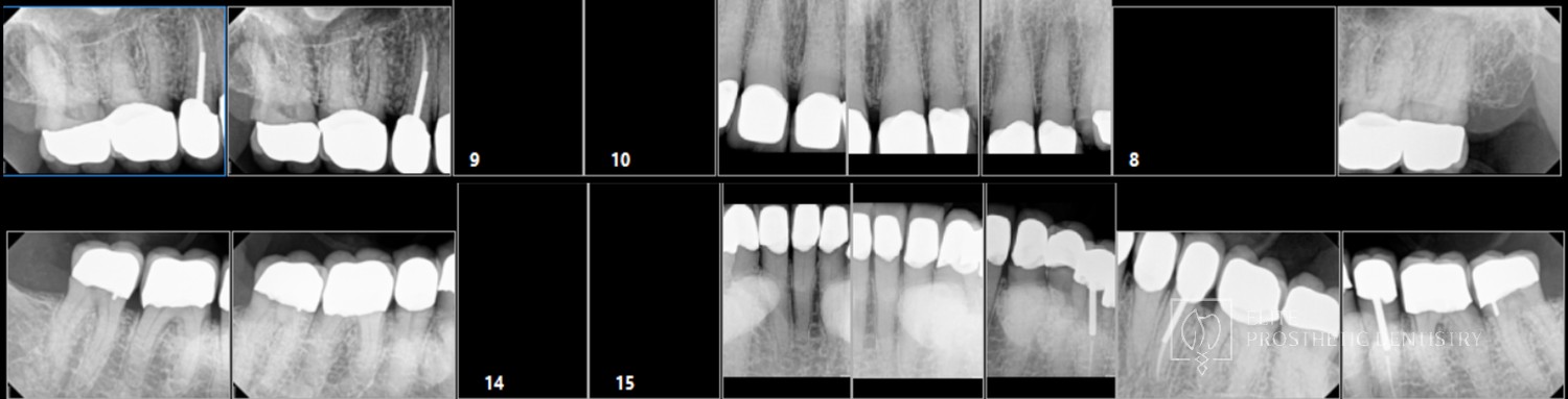 Post-treatment full-mouth radiographic series documenting marginal integrity where each crown meets the tooth and the supporting structure after coordinated restorative reconstruction at Elite Prosthetic Dentistry in Washington, DC