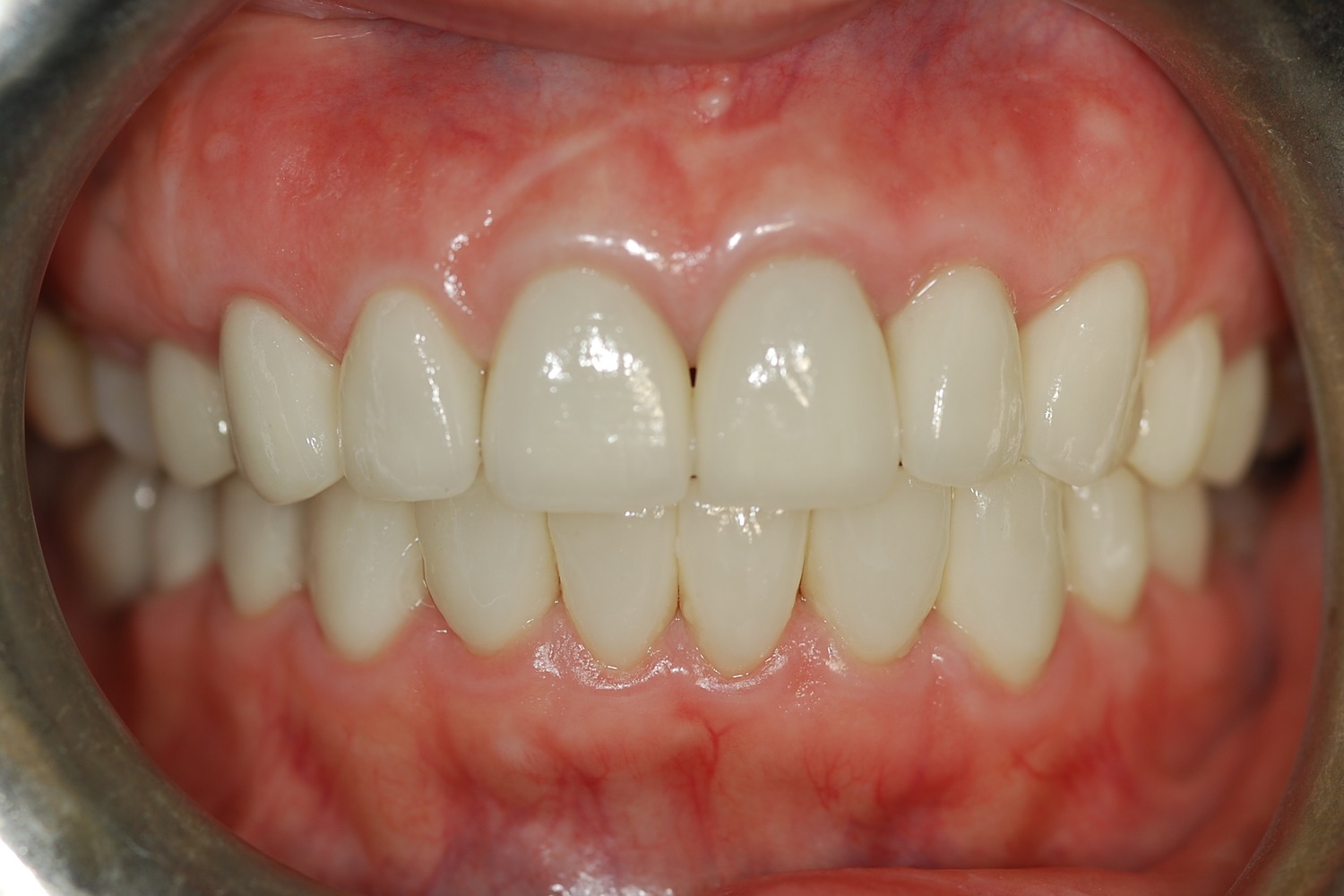 Final intraoral view after replacement with customized ceramic restorations.