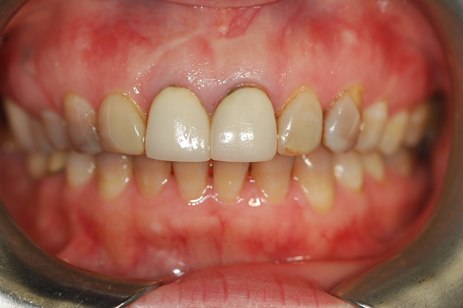 Pre-treatment intraoral view showing aging, opaque ceramic restorations.