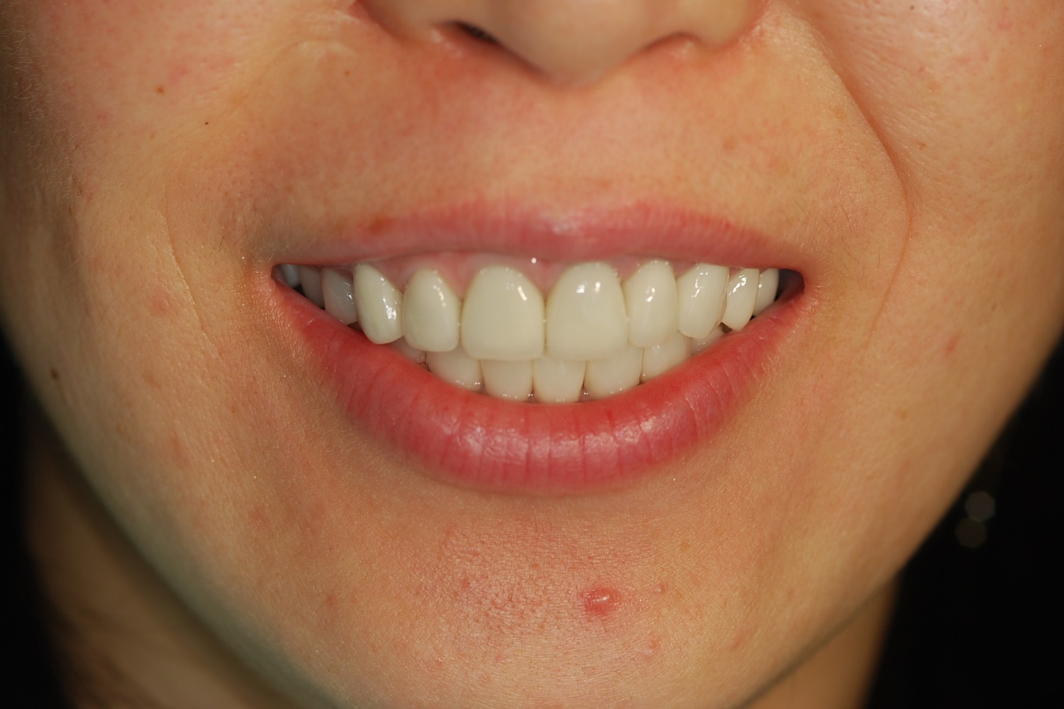 After treatment