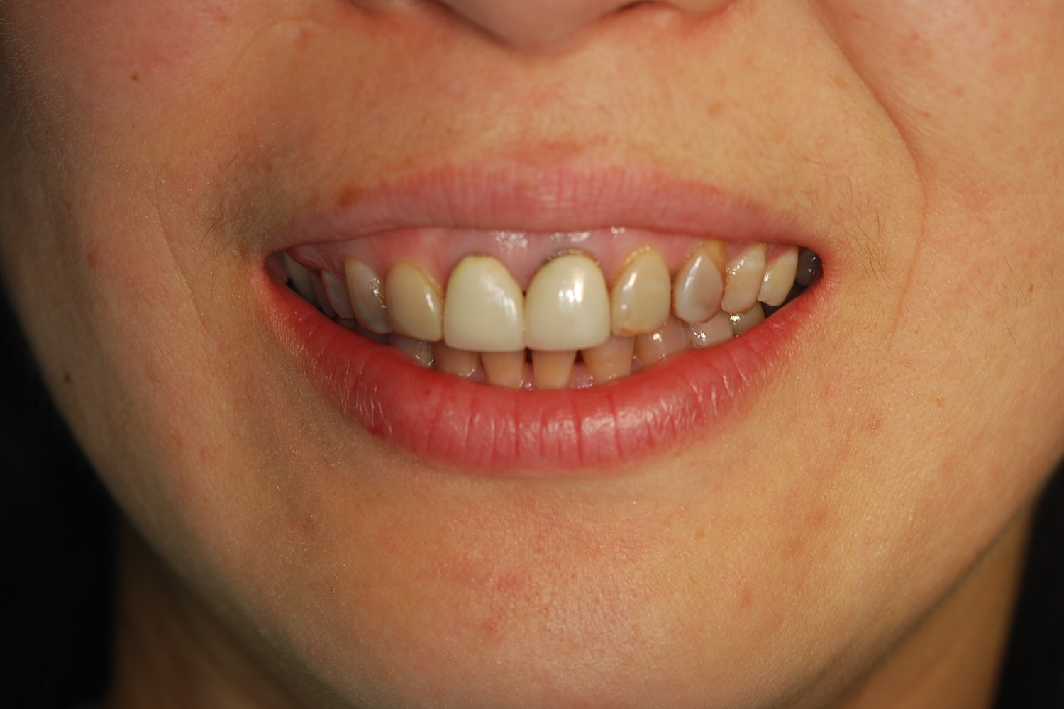 Before treatment
