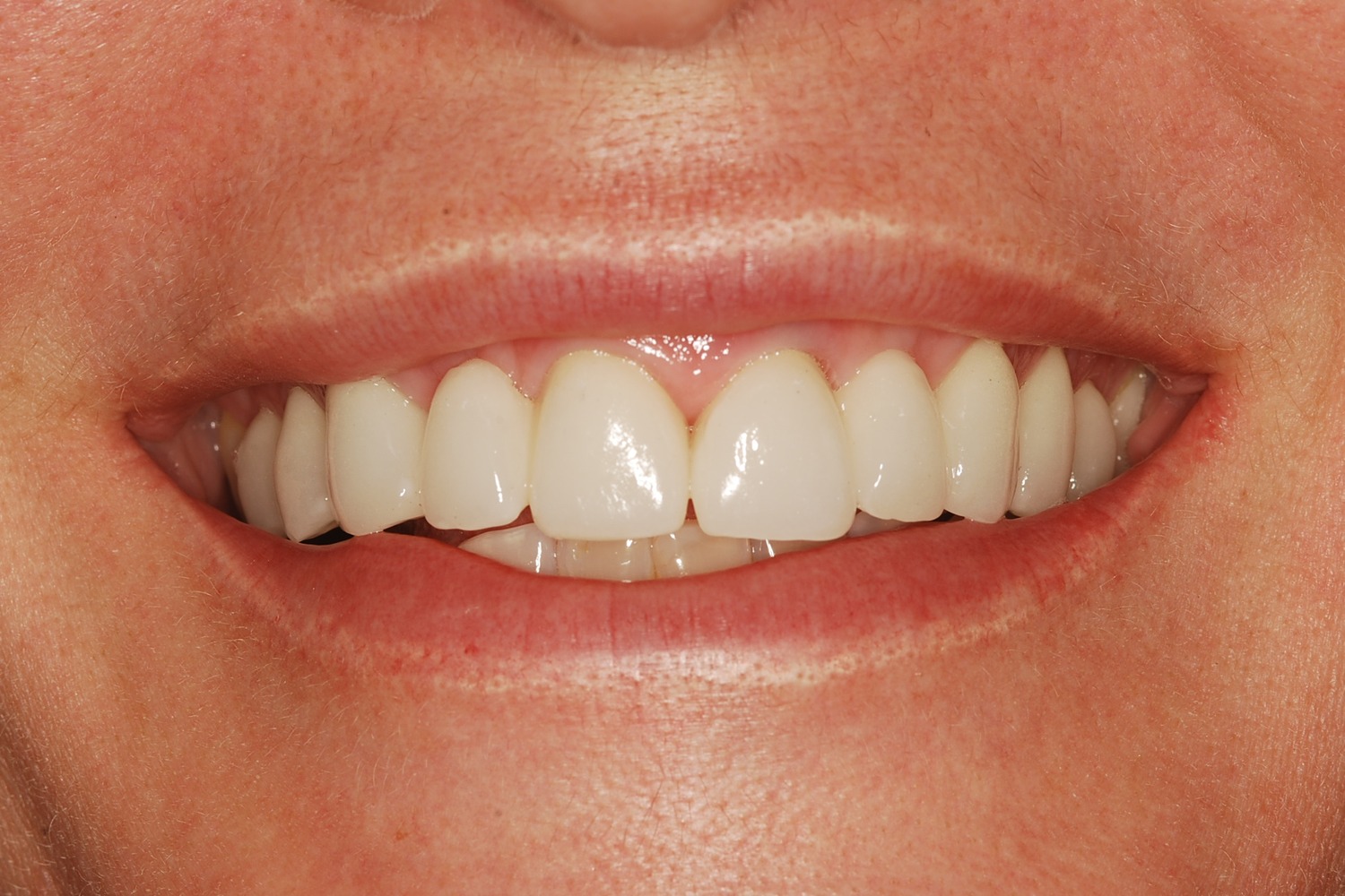After: How Failing Lateral Incisor Implants Were Replaced with Custom Zirconia Bridges After Severe Bone Loss Made Replacement Implants Impossible