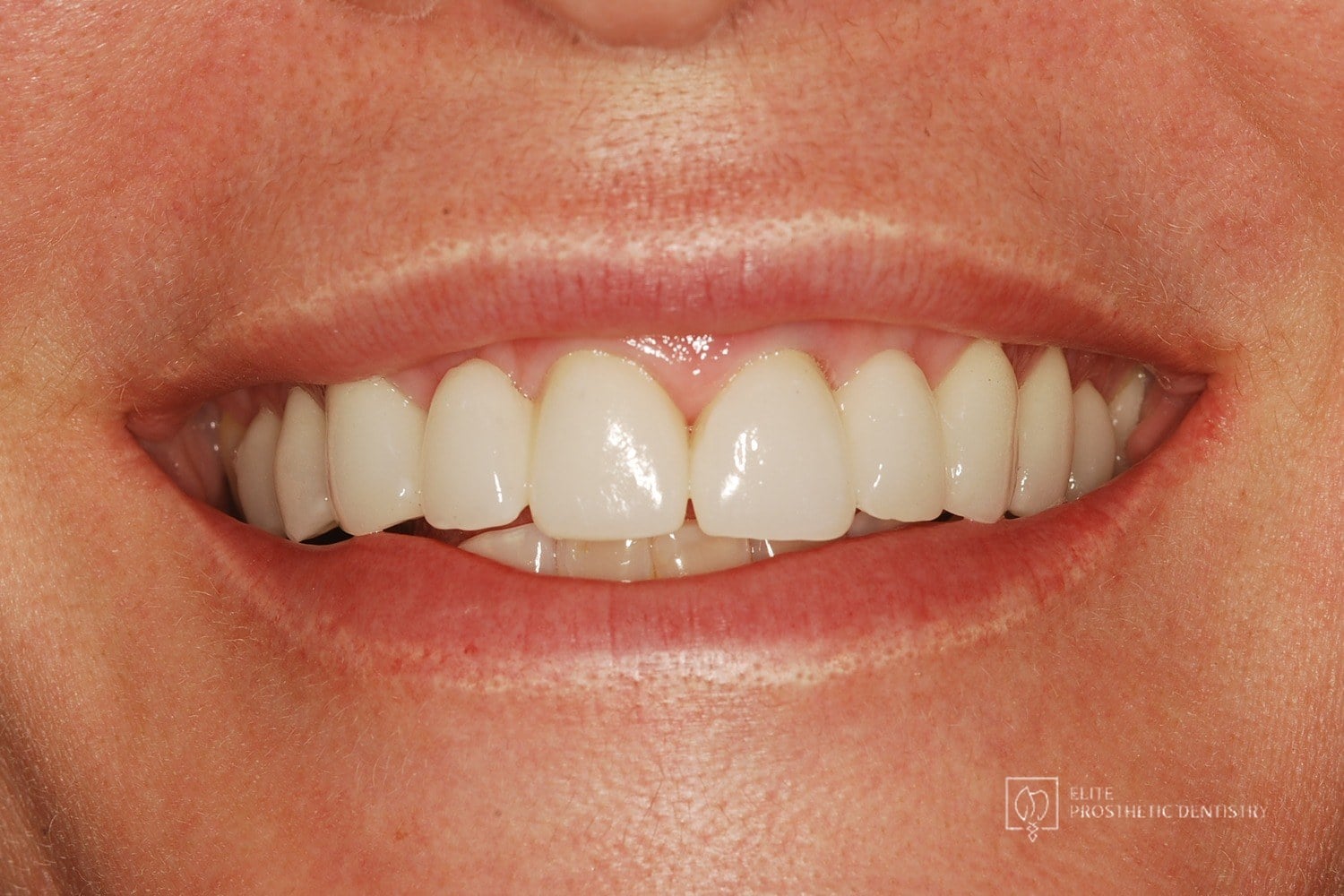 After: How Failing Lateral Incisor Implants Were Replaced with Custom Zirconia Bridges After Severe Bone Loss Made Replacement Implants Impossible