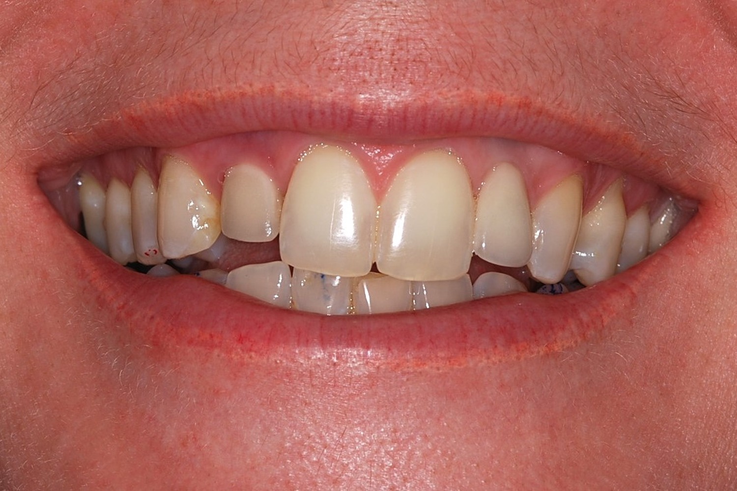 Before: How Failing Lateral Incisor Implants Were Replaced with Custom Zirconia Bridges After Severe Bone Loss Made Replacement Implants Impossible