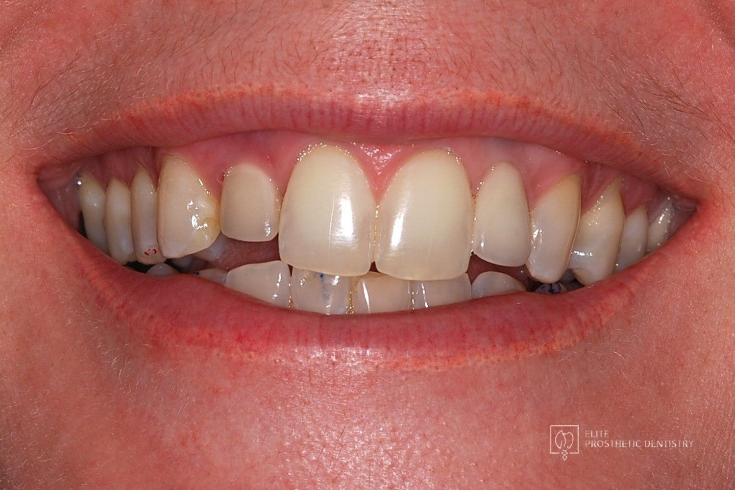 Before: How Failing Lateral Incisor Implants Were Replaced with Custom Zirconia Bridges After Severe Bone Loss Made Replacement Implants Impossible