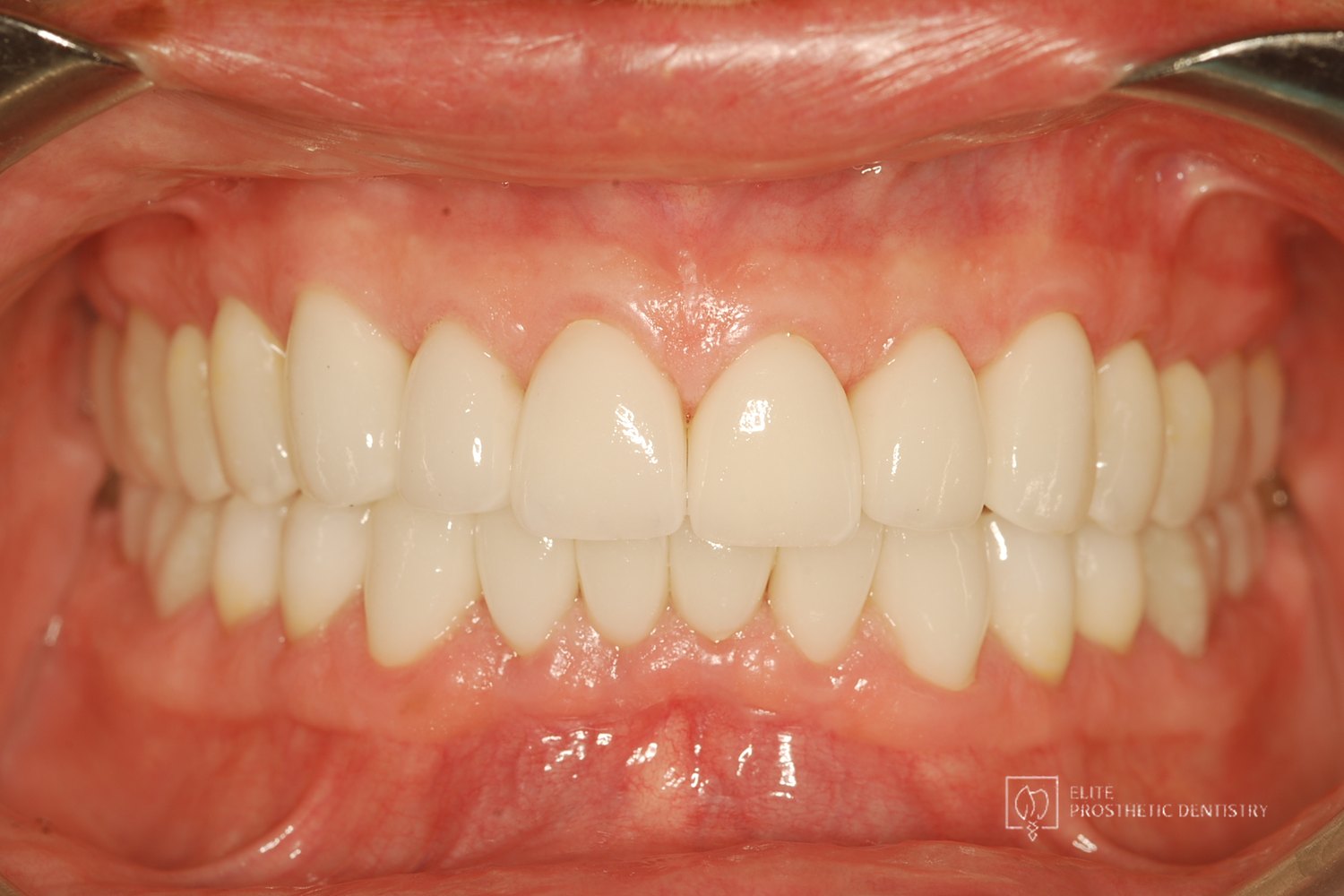 Retracted view three months after delivery, showing the restorations and gum tissue settling into the new bite.