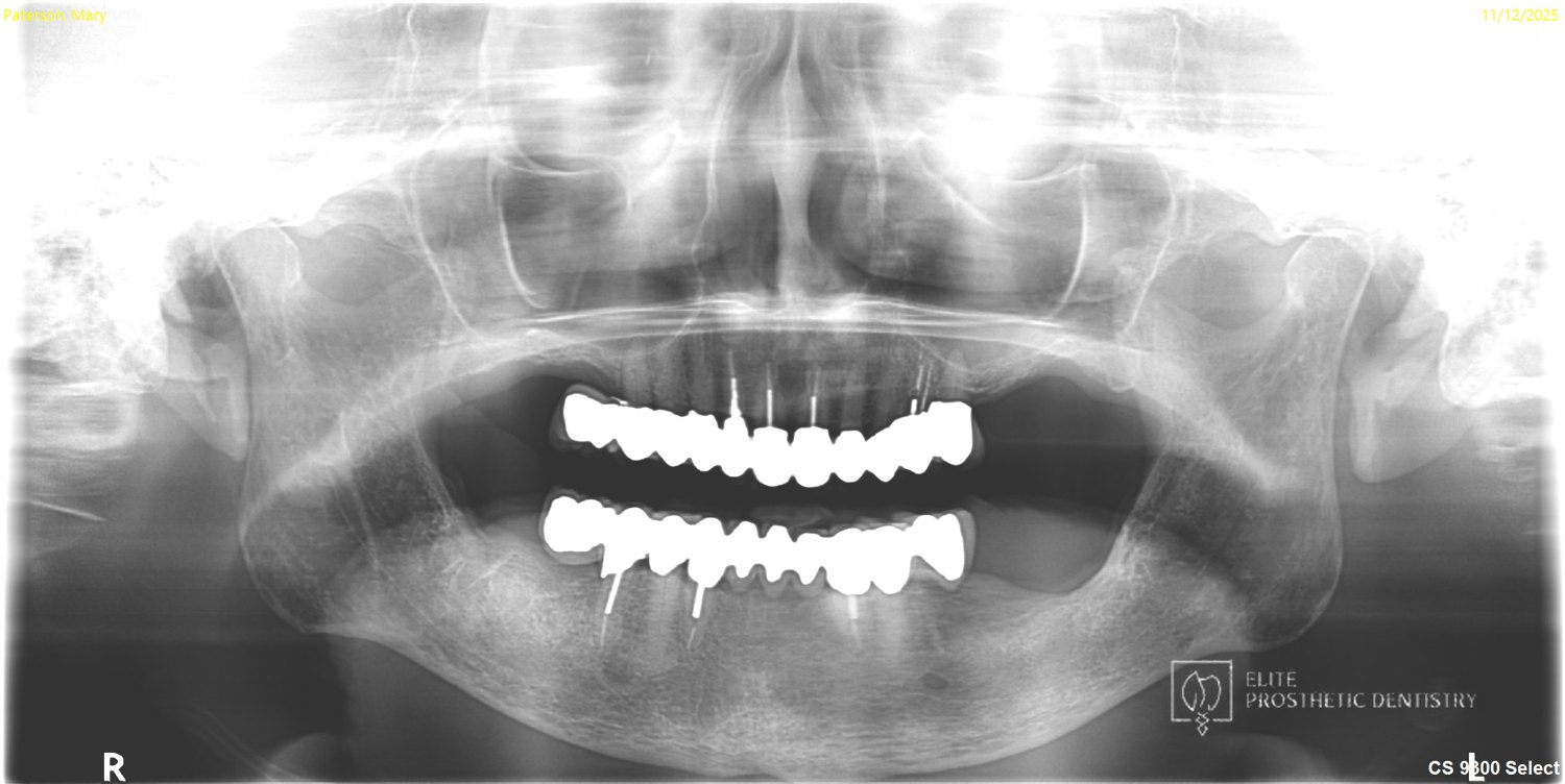 Panoramic radiograph after treatment showing the completed upper and lower reconstruction.